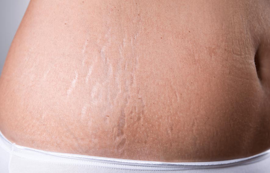 Stretch Marks Treatment Service in Orland Park